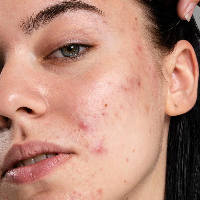 Akne na licu – Tretman i prevencija