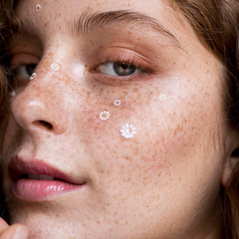 Hiperpigmentacija kože i lica