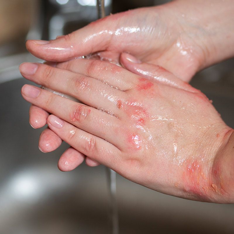 Ekcem – Uzroci, simptomi i nega kože