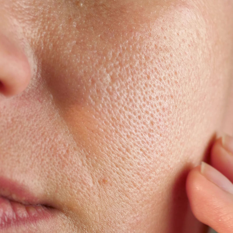 Šta su pore i zašto nastaju proširene pore na licu?