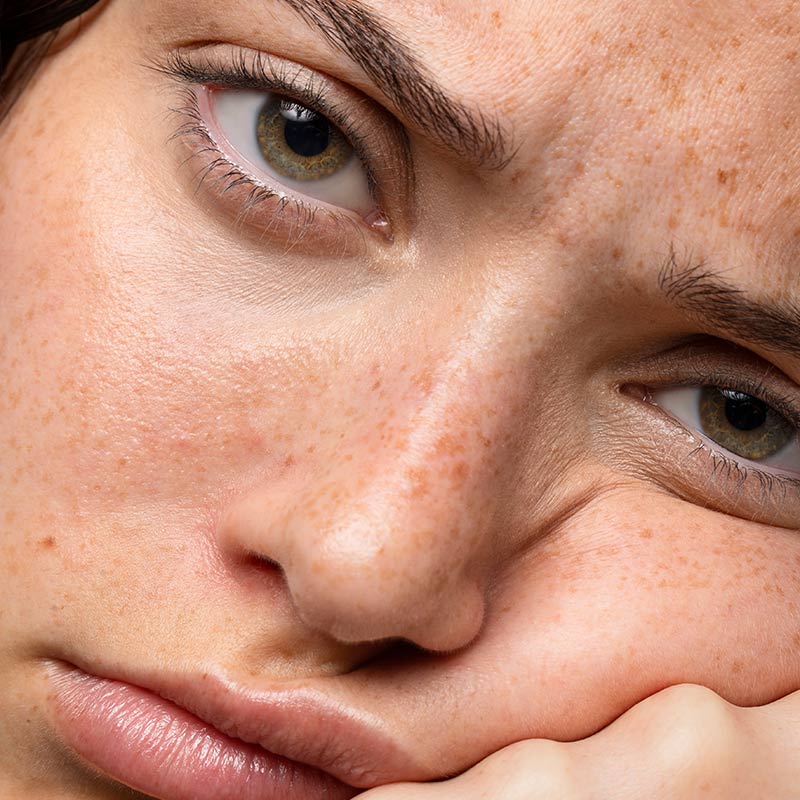 Fleke na licu – Uzroci, prevencija i tretman